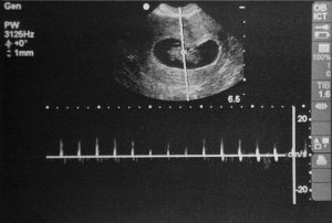 ultrassom de 5 semanas